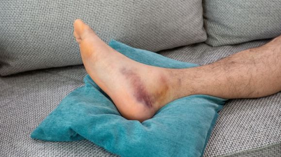 Entorsă de gleznă: tratament, recuperare și c&acirc;nd ai nevoie de o orteză